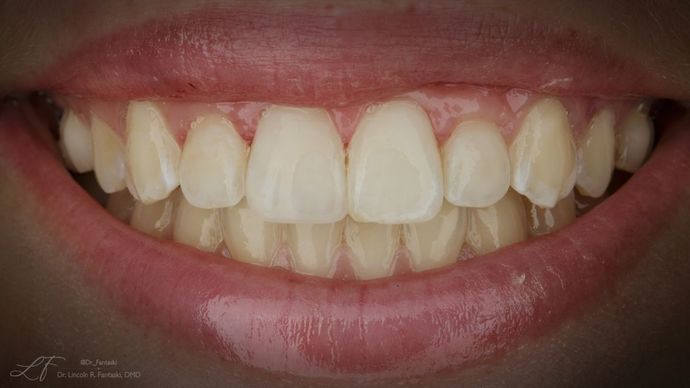 after cosmetic dentistry